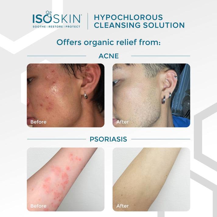 ISOCLEAN ISOSKIN Hypochlorous Cleansing Solution Spray 100ml