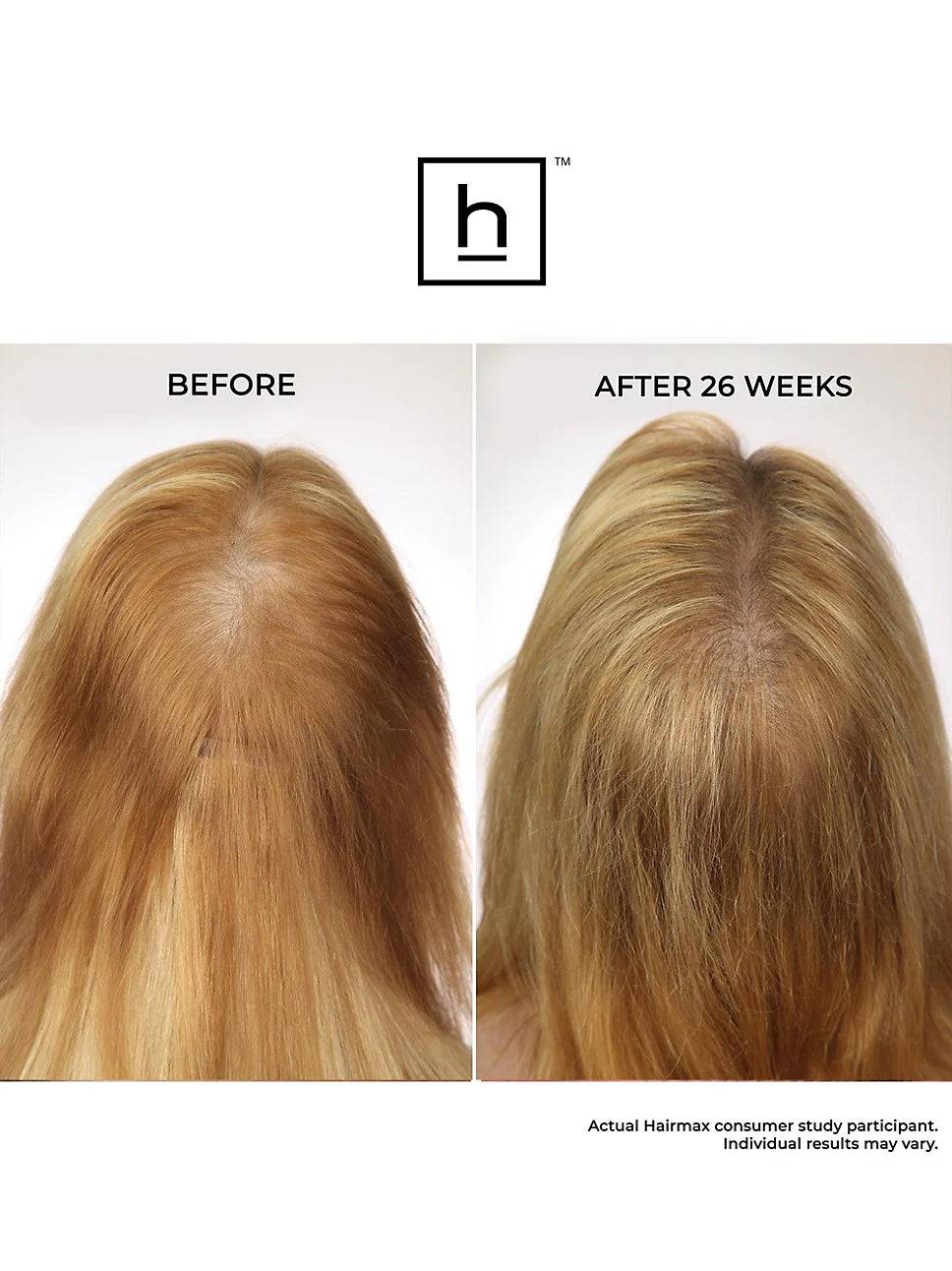 HairMax Laserband 82 Comfortflex
