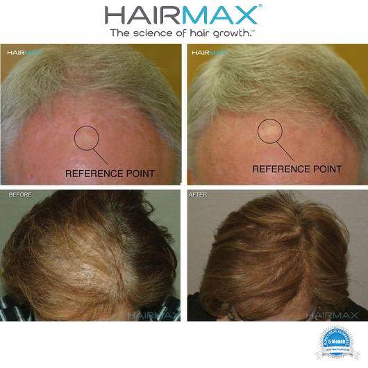 HairMax Powerflex 272 Laser Cap