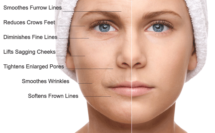 Micro-Needling Course (1 day intensive course)
